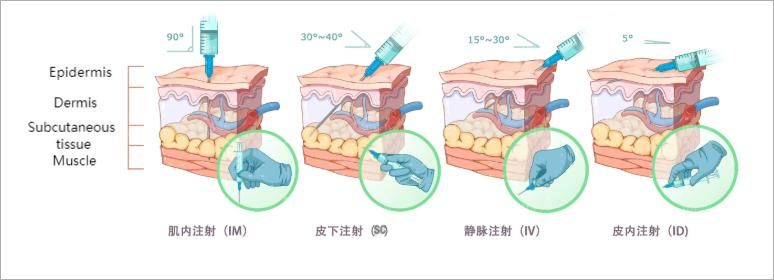 Major Injection Types